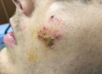 Impetigo - bakteriální infekce postihující kůži